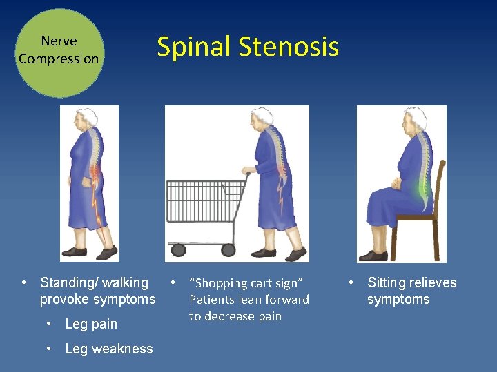 Nerve Compression • Standing/ walking provoke symptoms • Leg pain • Leg weakness Spinal