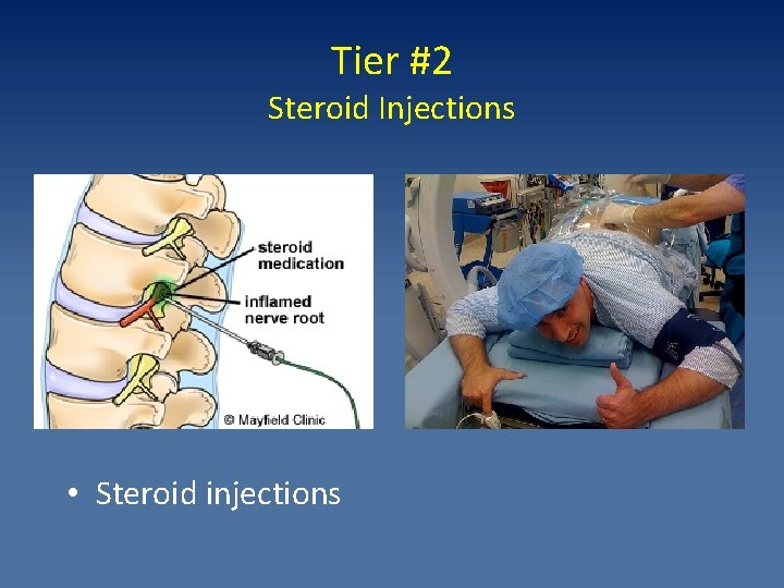 Tier #2 Steroid Injections • Steroid injections 