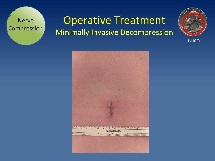 Nerve Compression Operative Treatment Minimally Invasive Decompression 18 mm 