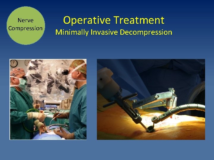 Nerve Compression Operative Treatment Minimally Invasive Decompression 