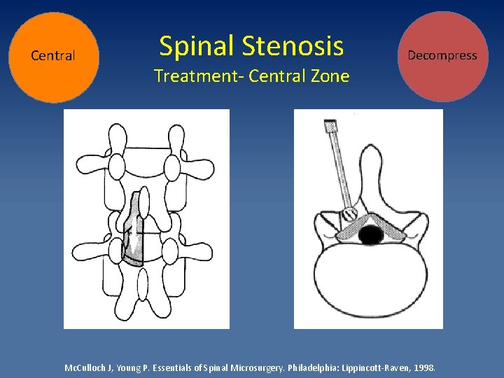 Central Spinal Stenosis Treatment- Central Zone Decompress Mc. Culloch J, Young P. Essentials of