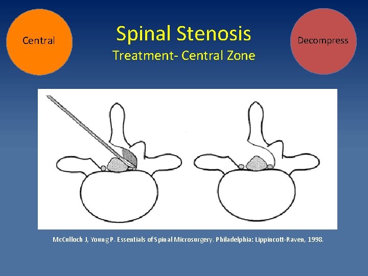 Central Spinal Stenosis Treatment- Central Zone Decompress Mc. Culloch J, Young P. Essentials of