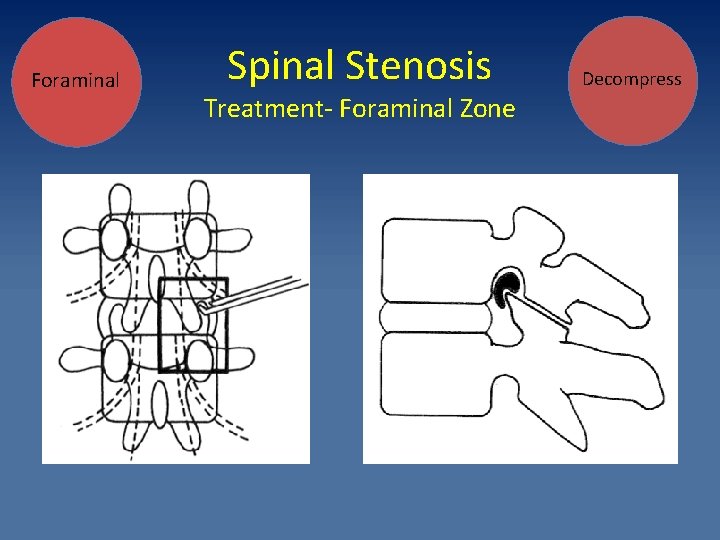 Foraminal Spinal Stenosis Treatment- Foraminal Zone Decompress 