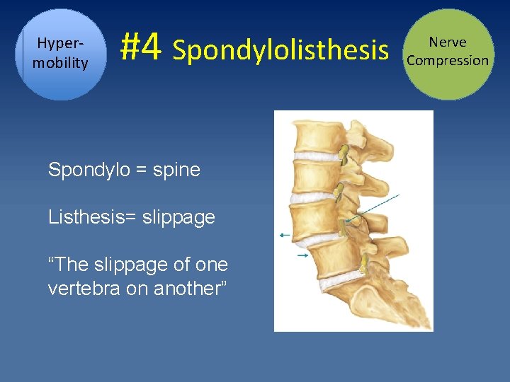 Hypermobility #4 Spondylolisthesis Spondylo = spine Listhesis= slippage “The slippage of one vertebra on