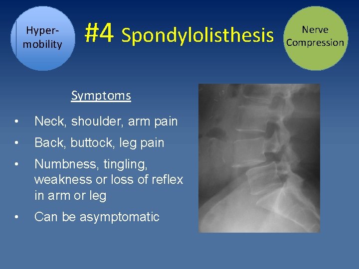 Hypermobility #4 Spondylolisthesis Symptoms • Neck, shoulder, arm pain • Back, buttock, leg pain