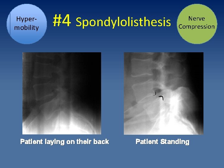 Hypermobility #4 Spondylolisthesis Patient laying on their back Nerve Compression Patient Standing 