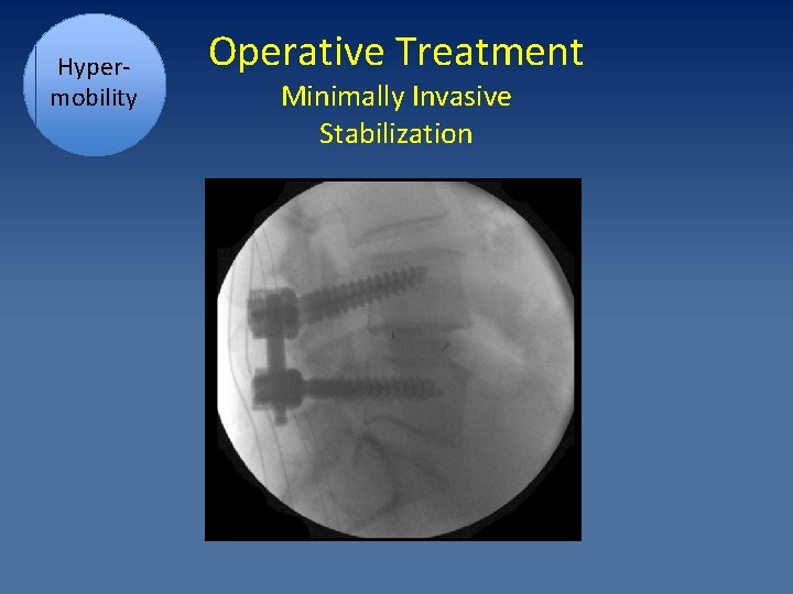 Hypermobility Operative Treatment Minimally Invasive Stabilization 