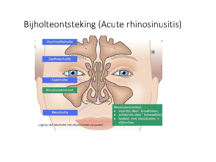 Bijholteontsteking (Acute rhinosinusitis) 