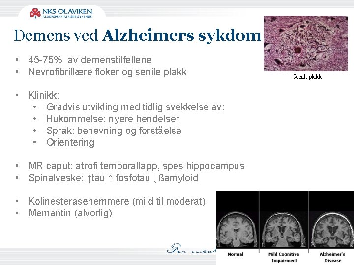 Demens ved Alzheimers sykdom • 45 -75% av demenstilfellene • Nevrofibrillære floker og senile