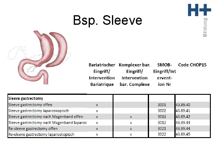 Bsp. Sleeve 