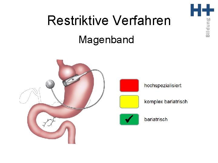 Restriktive Verfahren Magenband ü 