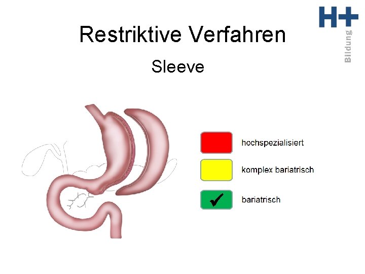 Restriktive Verfahren Sleeve ü 