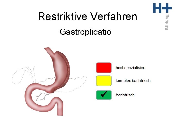 Restriktive Verfahren Gastroplicatio ü 