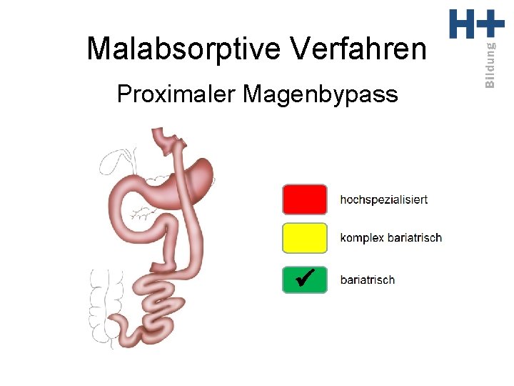 Malabsorptive Verfahren Proximaler Magenbypass ü 