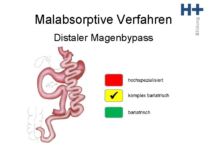 Malabsorptive Verfahren Distaler Magenbypass ü 