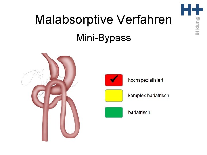 Malabsorptive Verfahren Mini-Bypass ü 