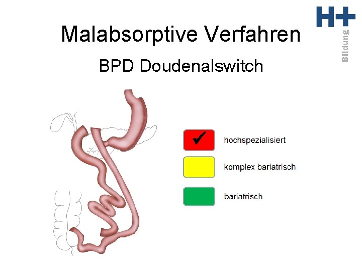 Malabsorptive Verfahren BPD Doudenalswitch ü 