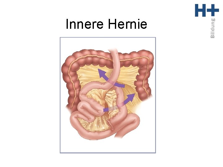 Innere Hernie 