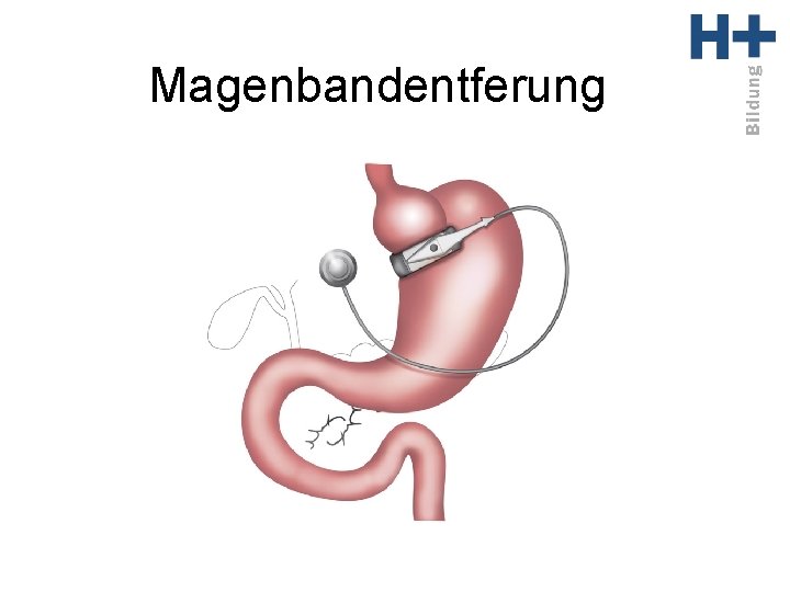 Magenbandentferung 