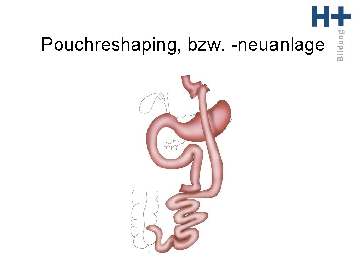 Pouchreshaping, bzw. -neuanlage 