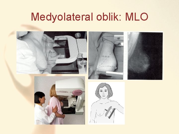 Medyolateral oblik: MLO 