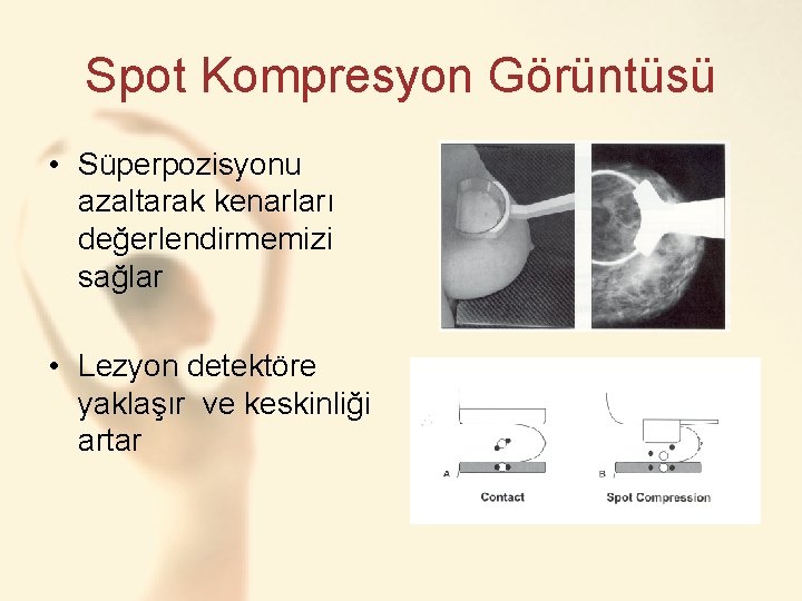 Spot Kompresyon Görüntüsü • Süperpozisyonu azaltarak kenarları değerlendirmemizi sağlar • Lezyon detektöre yaklaşır ve