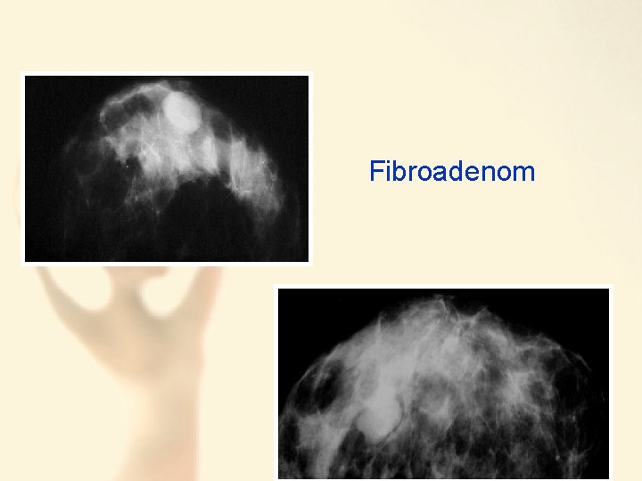 Fibroadenom 