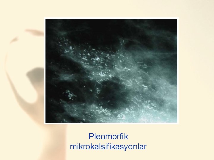Pleomorphic microcalc Pleomorfik mikrokalsifikasyonlar 