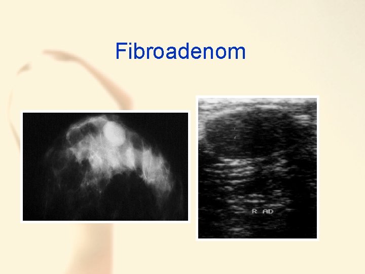 Fibroadenom 