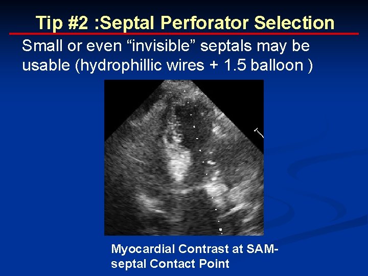 Tip #2 : Septal Perforator Selection Small or even “invisible” septals may be usable