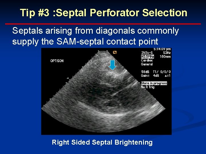 Tip #3 : Septal Perforator Selection Septals arising from diagonals commonly supply the SAM-septal