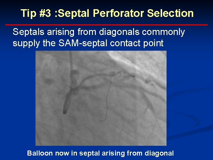 Tip #3 : Septal Perforator Selection Septals arising from diagonals commonly supply the SAM-septal