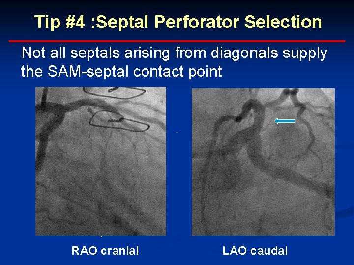 Tip #4 : Septal Perforator Selection Not all septals arising from diagonals supply the