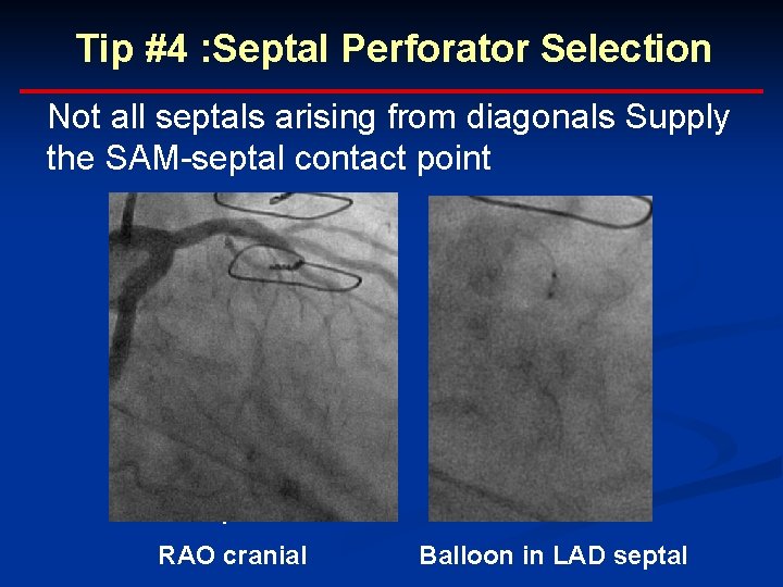 Tip #4 : Septal Perforator Selection Not all septals arising from diagonals Supply the