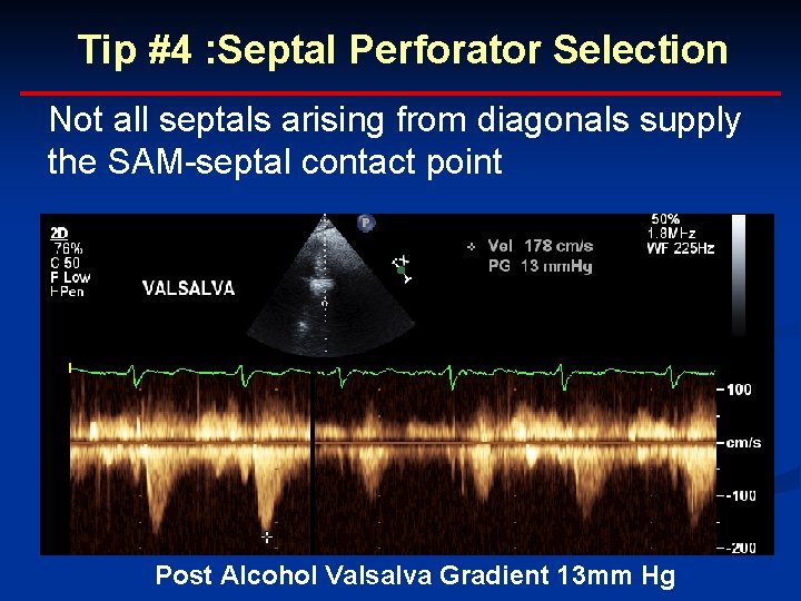 Tip #4 : Septal Perforator Selection Not all septals arising from diagonals supply the