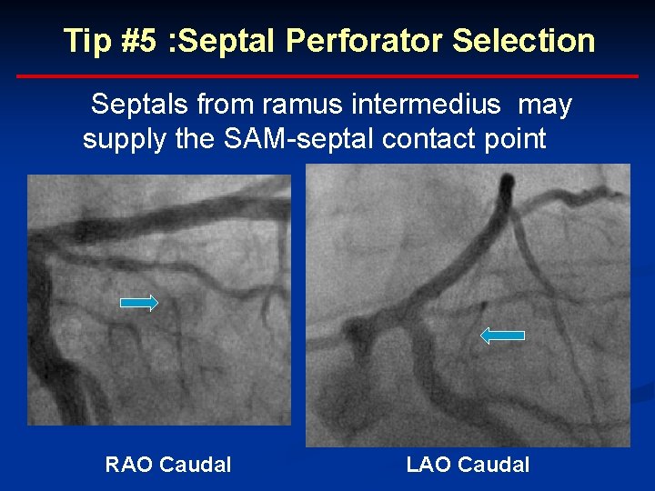 Tip #5 : Septal Perforator Selection Septals from ramus intermedius may supply the SAM-septal