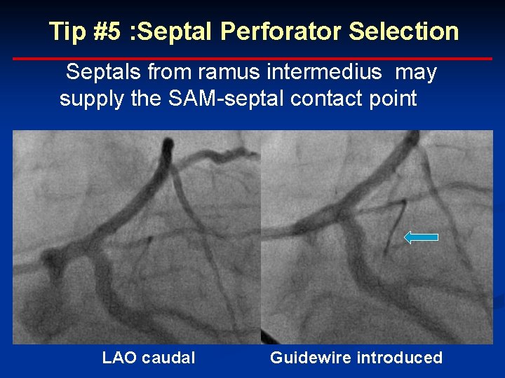 Tip #5 : Septal Perforator Selection Septals from ramus intermedius may supply the SAM-septal