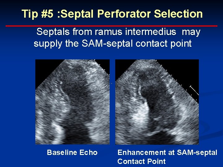 Tip #5 : Septal Perforator Selection Septals from ramus intermedius may supply the SAM-septal