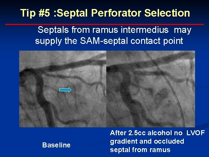 Tip #5 : Septal Perforator Selection Septals from ramus intermedius may supply the SAM-septal