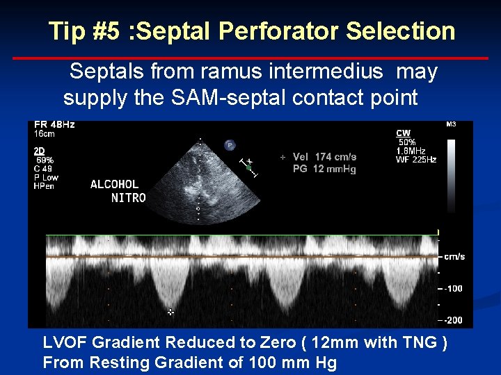 Tip #5 : Septal Perforator Selection Septals from ramus intermedius may supply the SAM-septal