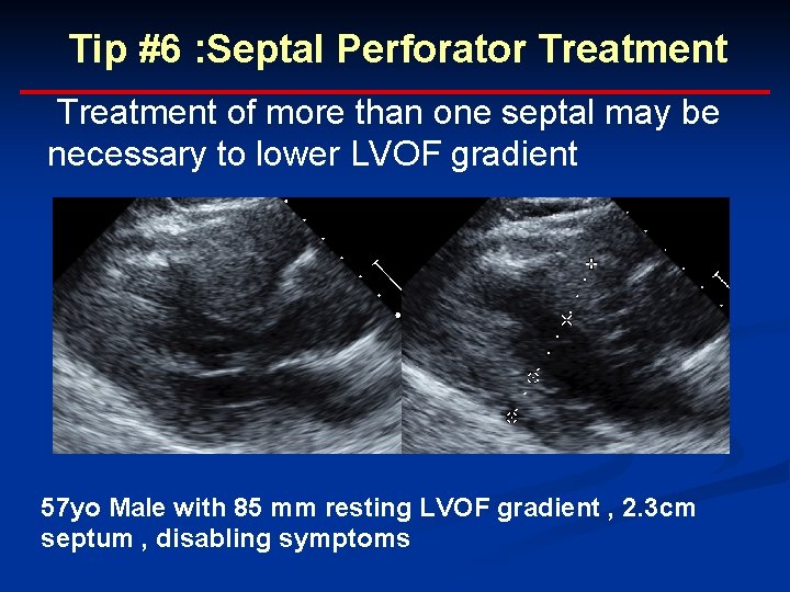 Tip #6 : Septal Perforator Treatment of more than one septal may be necessary