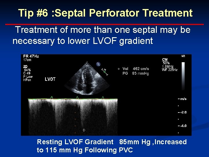 Tip #6 : Septal Perforator Treatment of more than one septal may be necessary