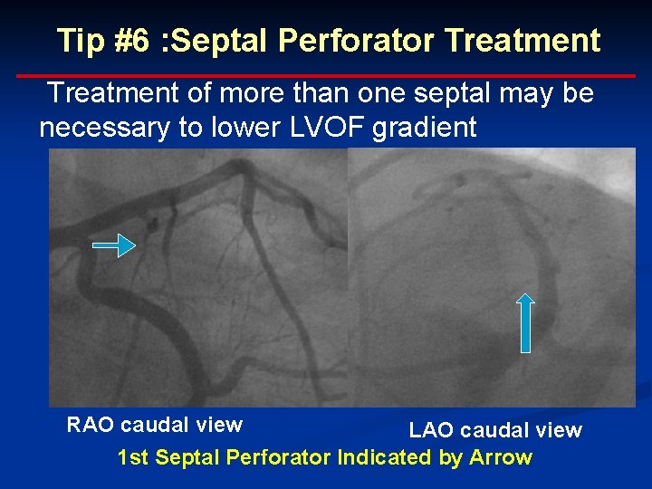 Tip #6 : Septal Perforator Treatment of more than one septal may be necessary