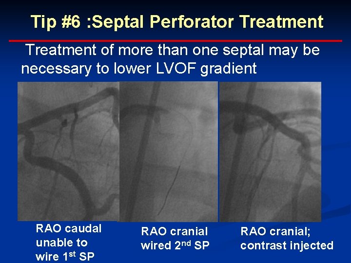 Tip #6 : Septal Perforator Treatment of more than one septal may be necessary