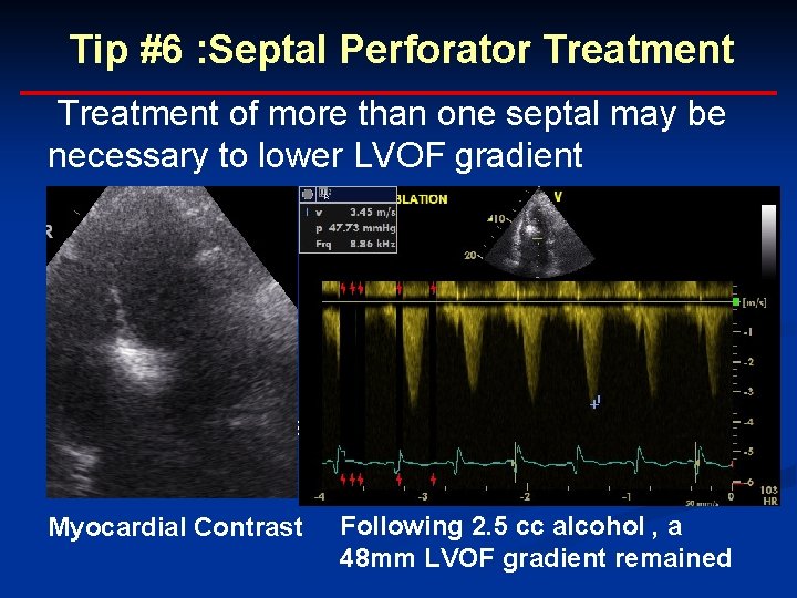 Tip #6 : Septal Perforator Treatment of more than one septal may be necessary