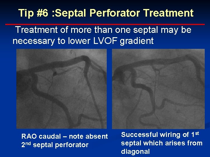 Tip #6 : Septal Perforator Treatment of more than one septal may be necessary