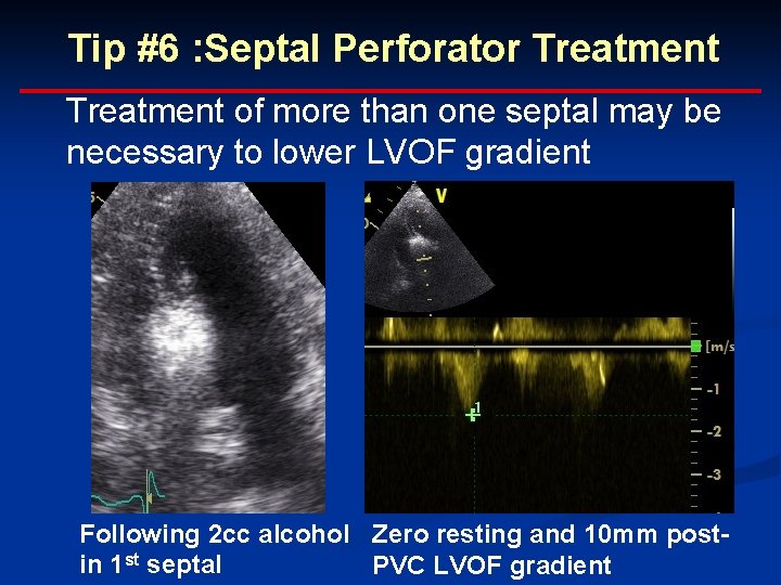 Tip #6 : Septal Perforator Treatment of more than one septal may be necessary