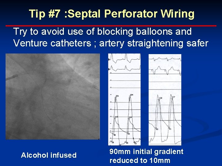 Tip #7 : Septal Perforator Wiring Try to avoid use of blocking balloons and