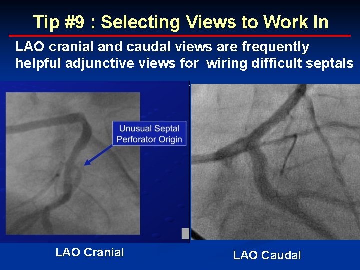 Tip #9 : Selecting Views to Work In LAO cranial and caudal views are