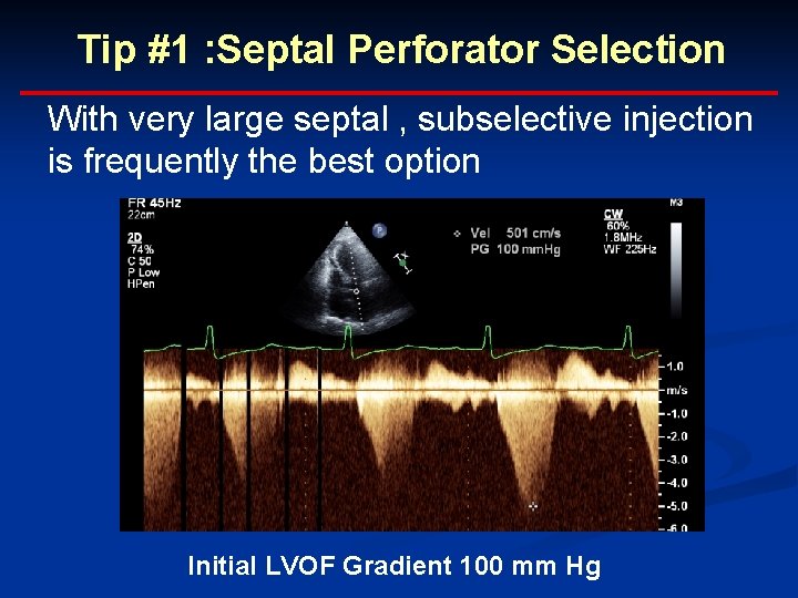 Tip #1 : Septal Perforator Selection With very large septal , subselective injection is